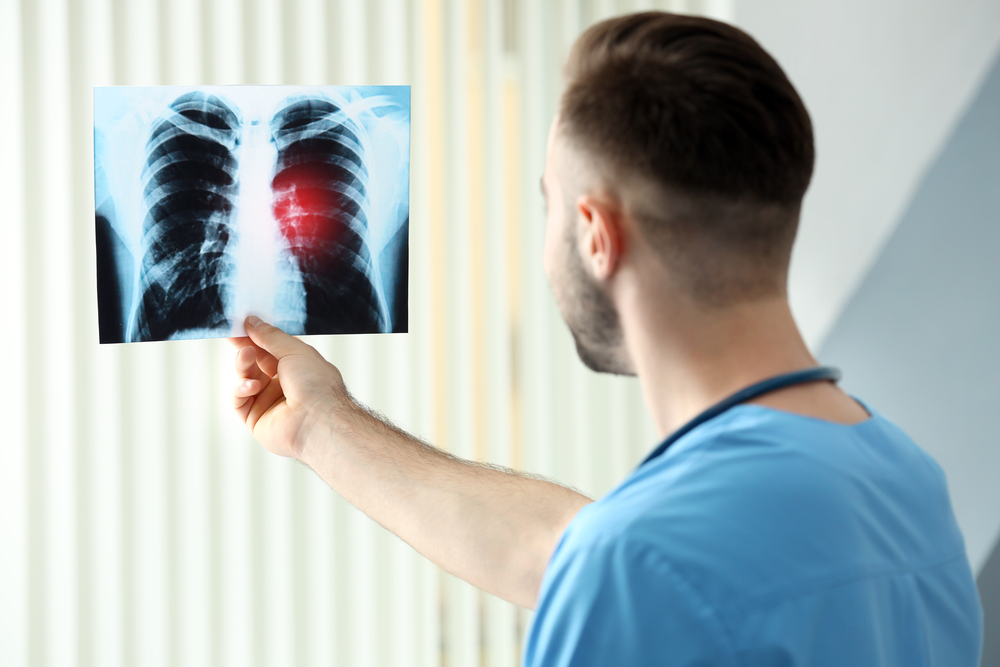 Comprehensive Guide to Lung Cancer: Causes, Detection, Symptoms, and Modern Treatments