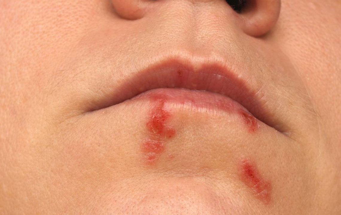 Comprehensive Natural Strategies for Cold Sore Relief and Faster Healing
