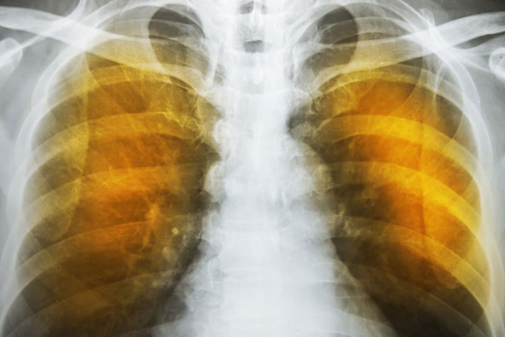 Understanding Emphysema: Causes, Risks, and Management