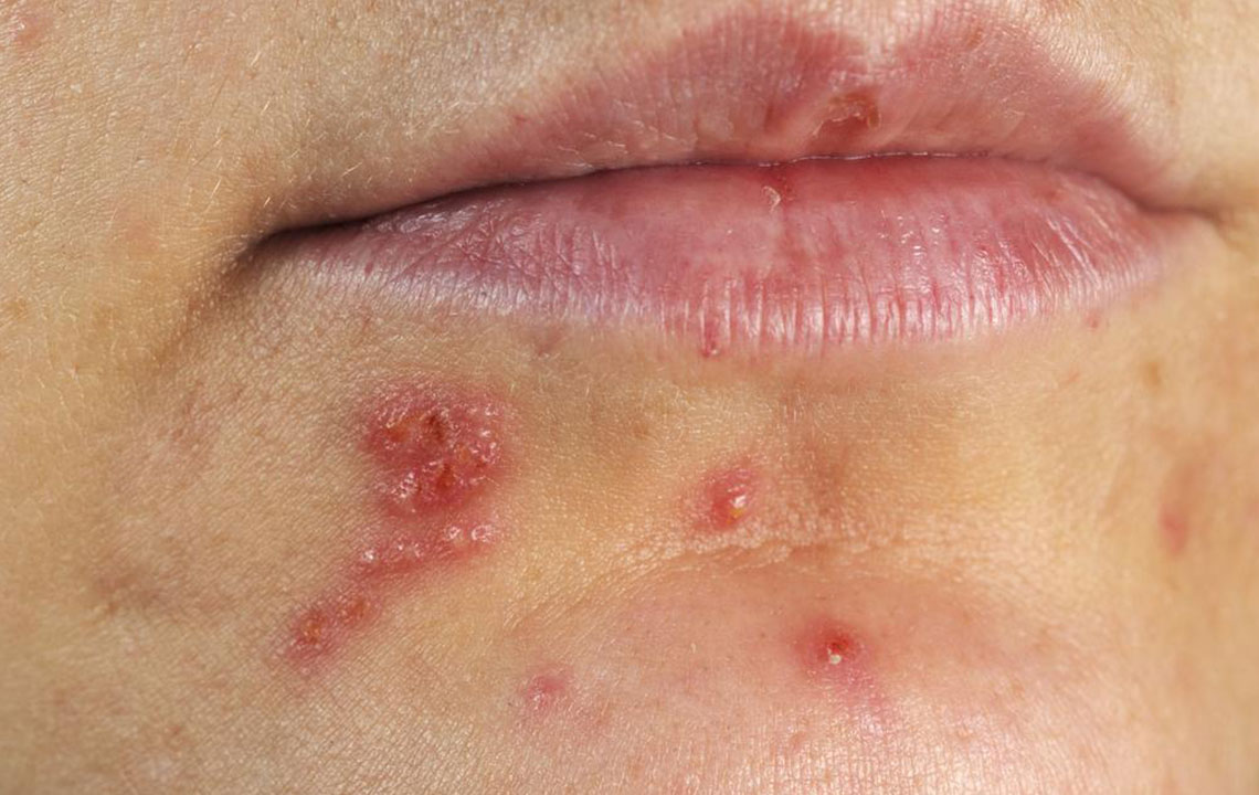 Top Strategies for Managing Herpes Effectively