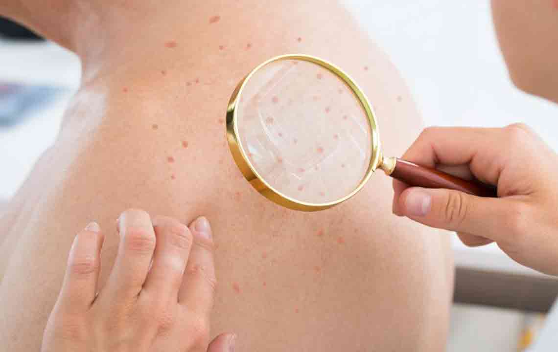 Understanding Atopic Dermatitis: Causes, Symptoms, and Management