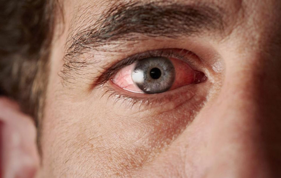 Causes and Risk Factors of Persistent Dry Eye Disease