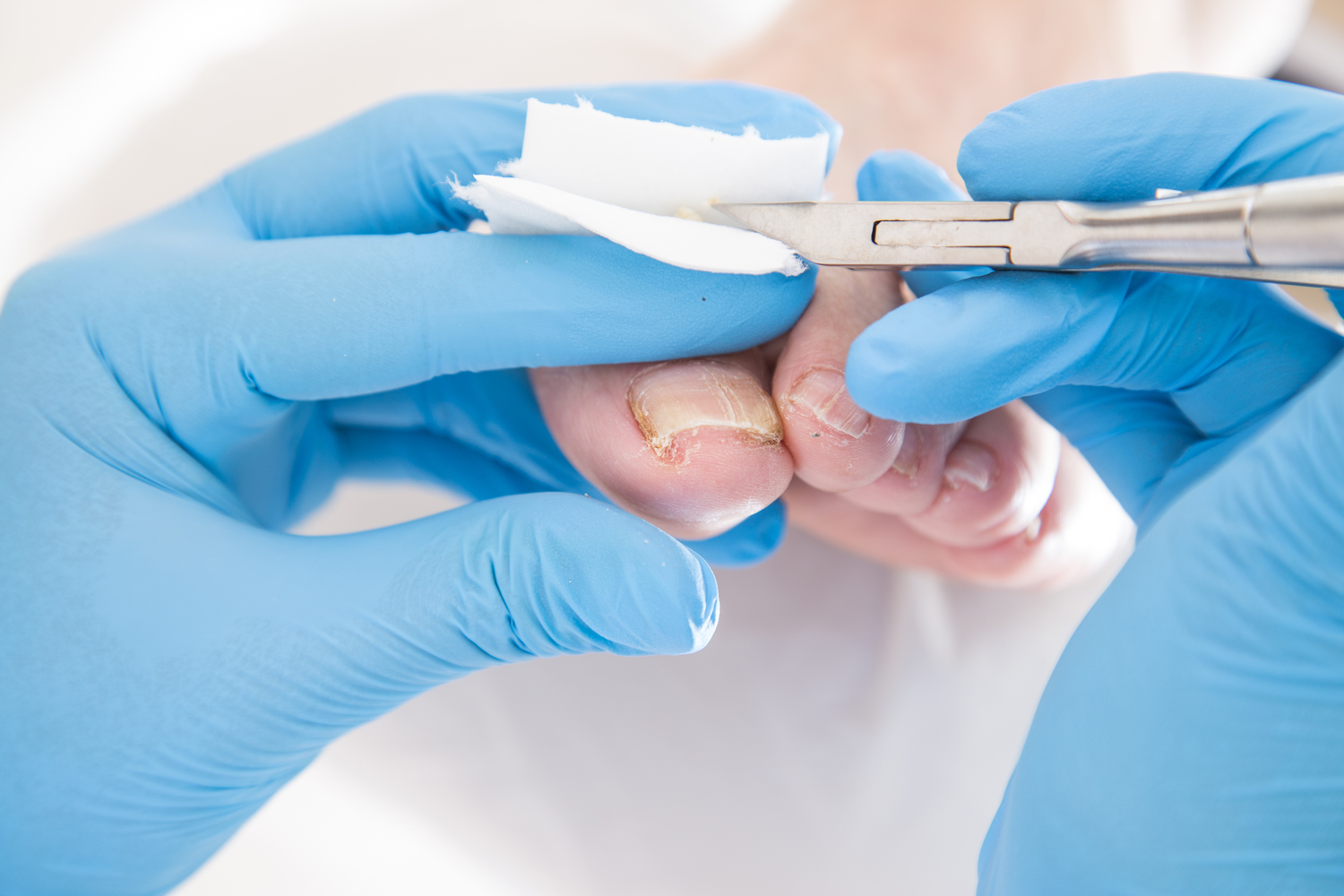 Comprehensive Guide to Toenail Fungal Infections: Prevention and Treatment Strategies