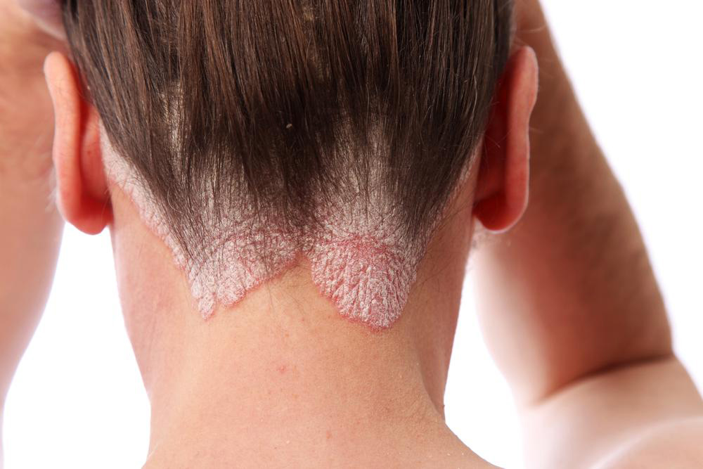 Understanding Scalp Psoriasis: Symptoms, Causes, and Treatment Options