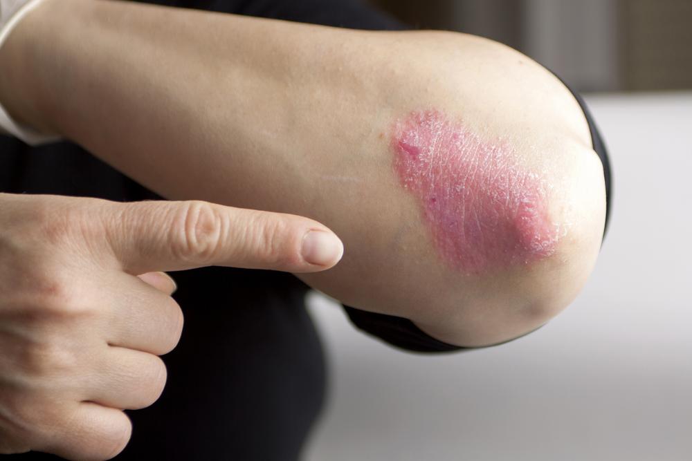 Understanding the Key Triggers of Psoriasis