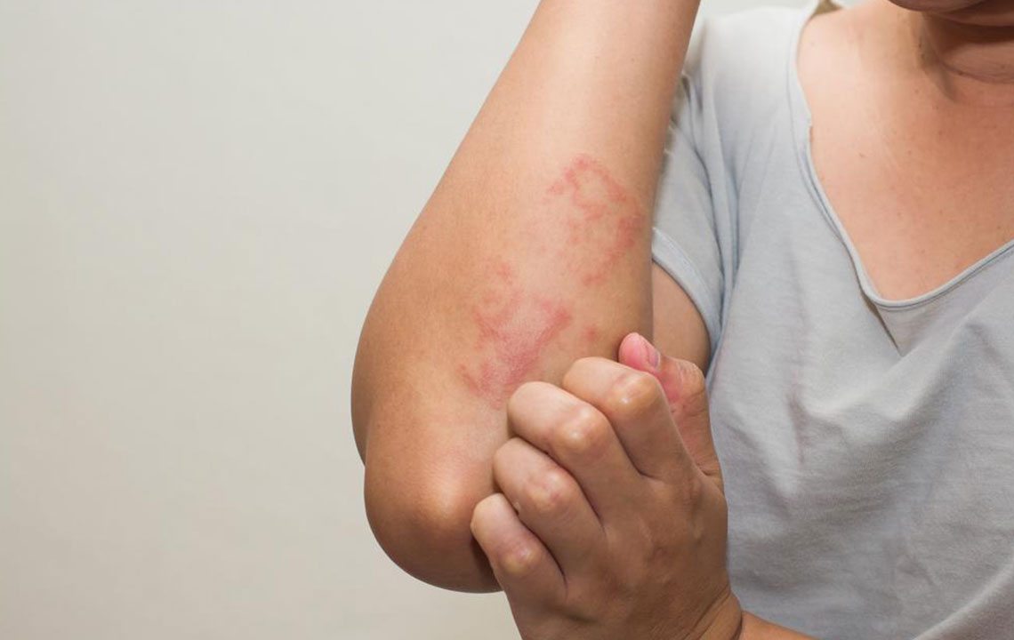 Effective Strategies for Managing Eczema Symptoms