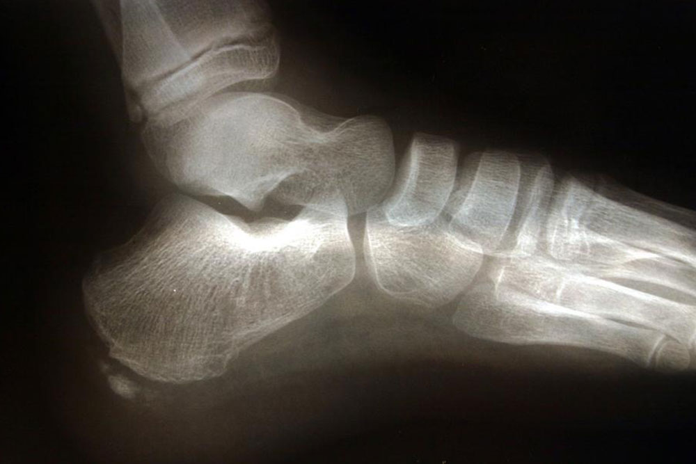 Natural Remedies to Soothe Heel Spurs Effectively
