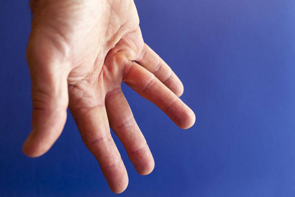 Understanding Dupuytren's Contracture: Causes, Symptoms, and Treatments