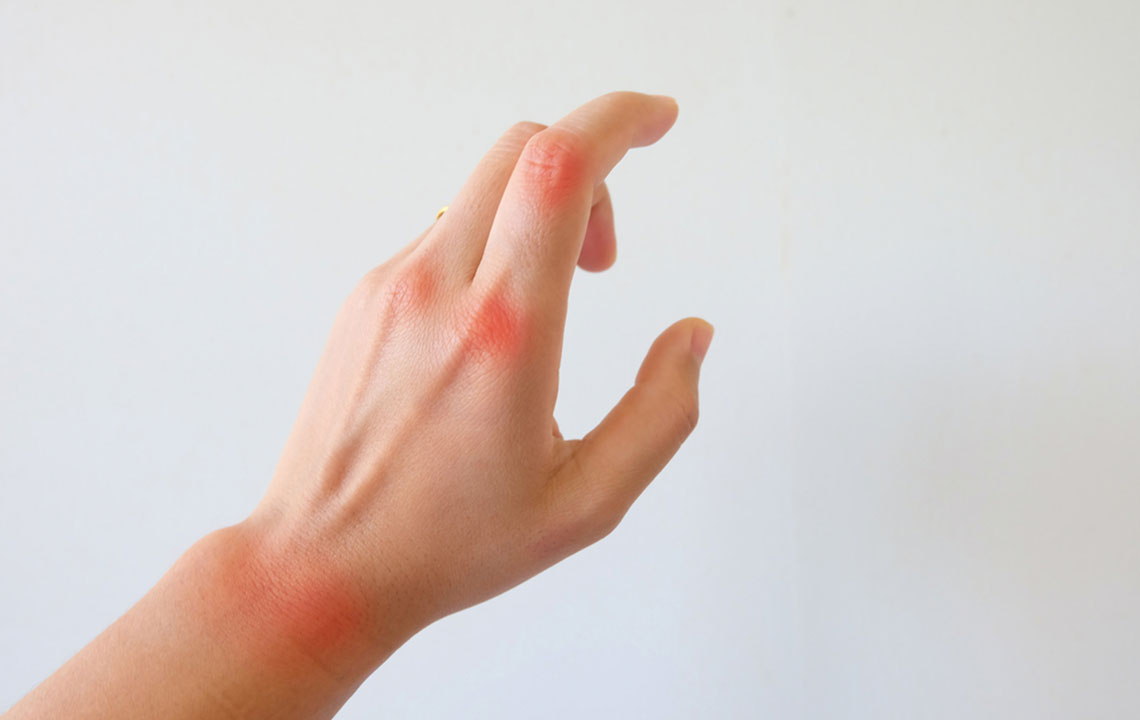 Effective Management Strategies for Rheumatoid Arthritis