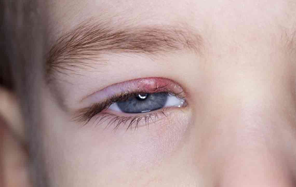 Effective Methods to Treat and Remove Styes