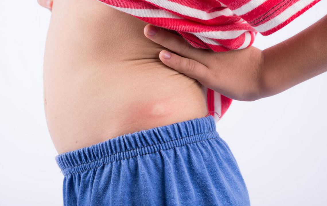 Effective Daily Habits for Managing Shingles Symptoms