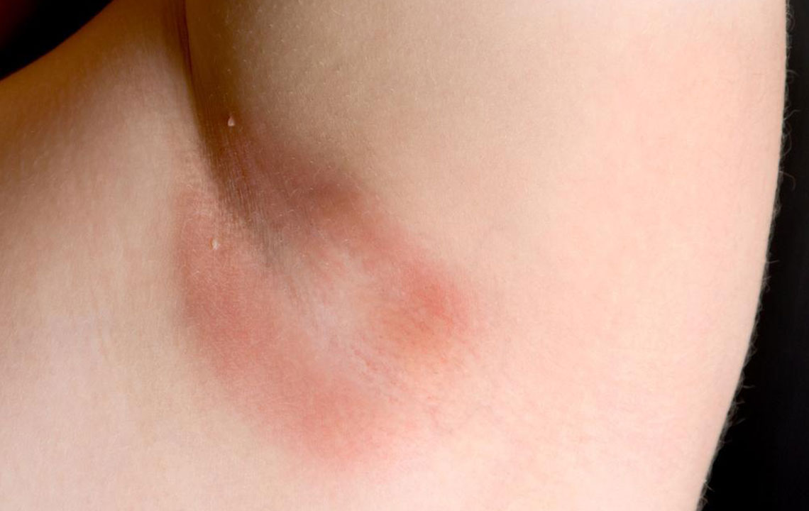 Top Natural Remedies for Underarm Skin Irritation