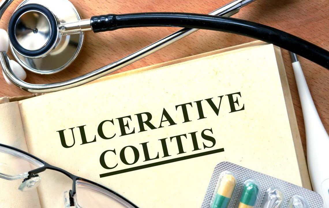 Managing and Preventing Ulcerative Colitis Flare-Ups
