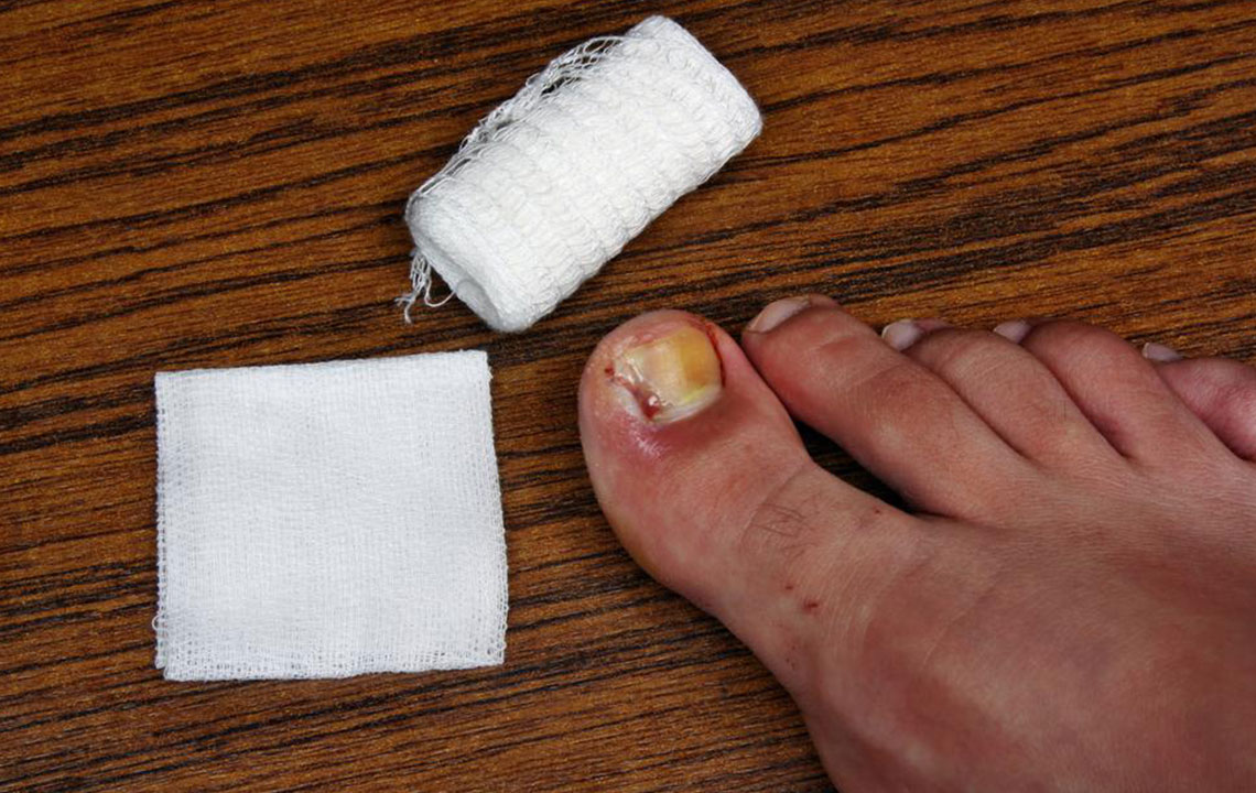Effective Strategies for Treating and Preventing Toenail Fungal Infections