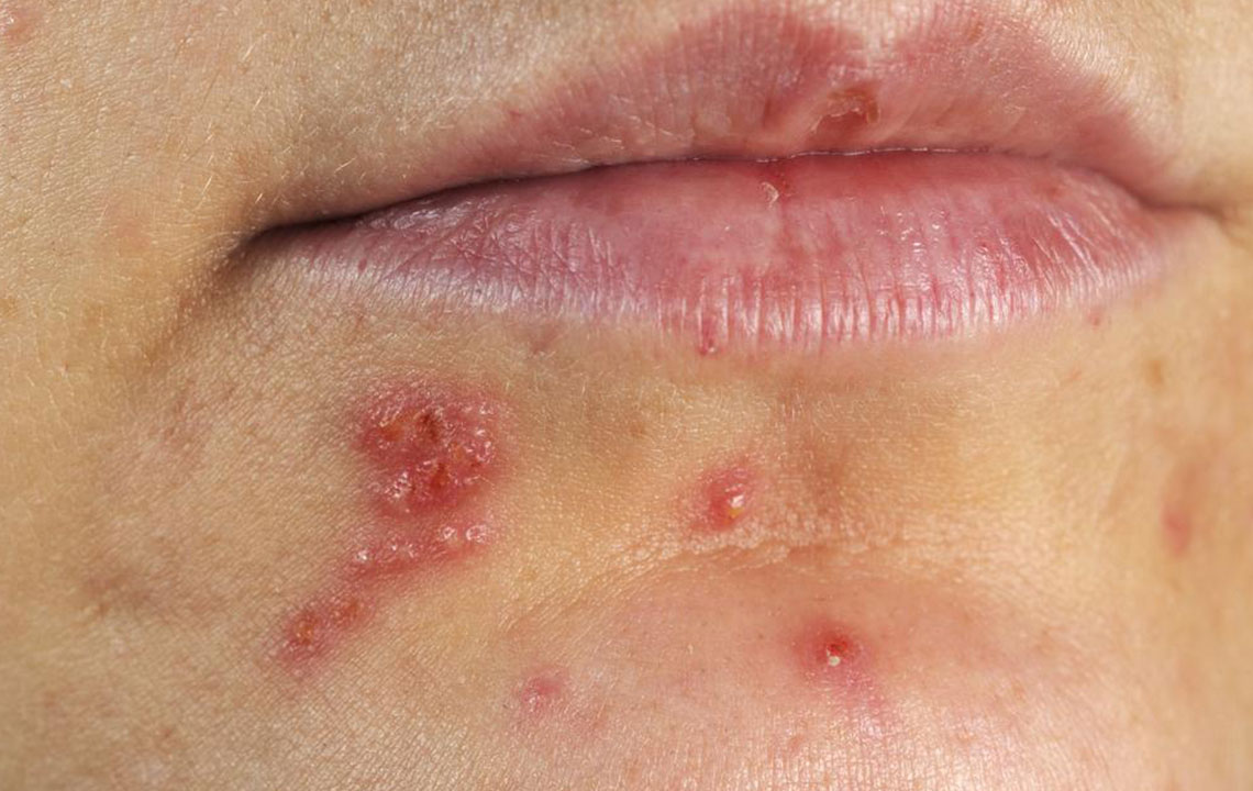 Herpes Management Through Diet: Essential Nutritional Tips