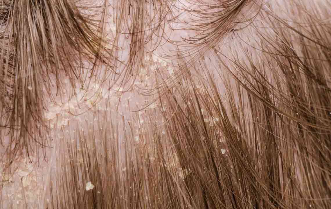 Effective Mild Strategies for Managing Scalp Psoriasis
