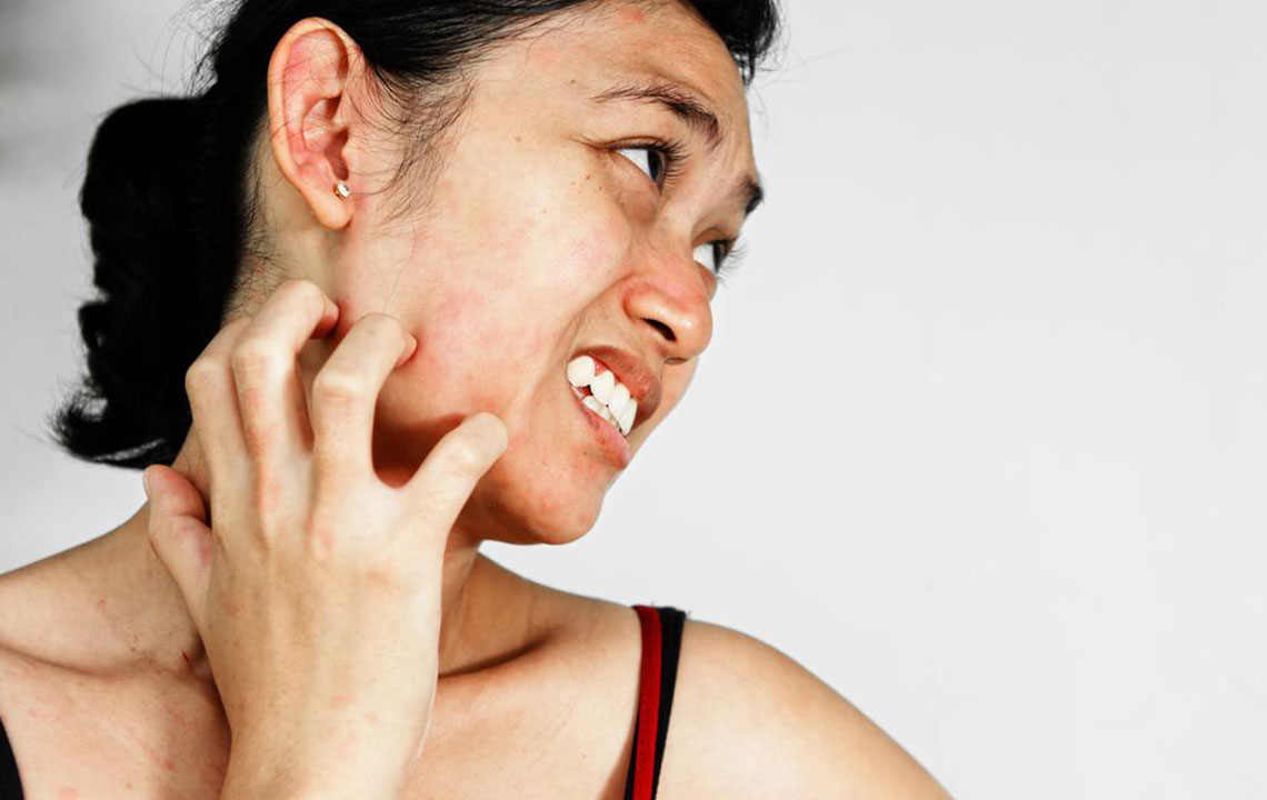 Comprehensive Guide to Rosacea Treatment Options