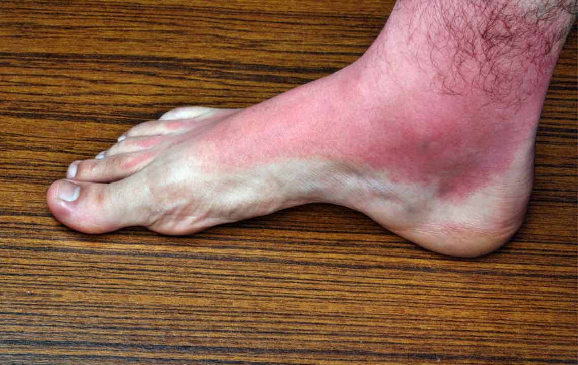 Understanding Heat Rash: Causes, Symptoms, and Remedies