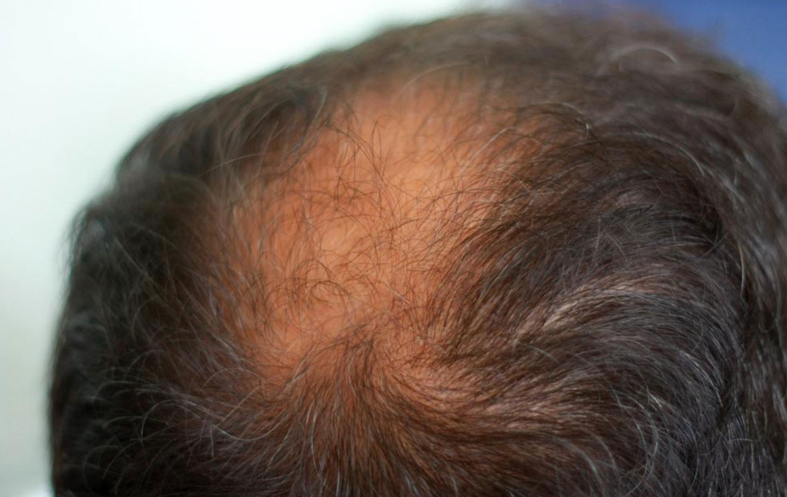 Natural Remedies to Combat Hair Thinning Effectively