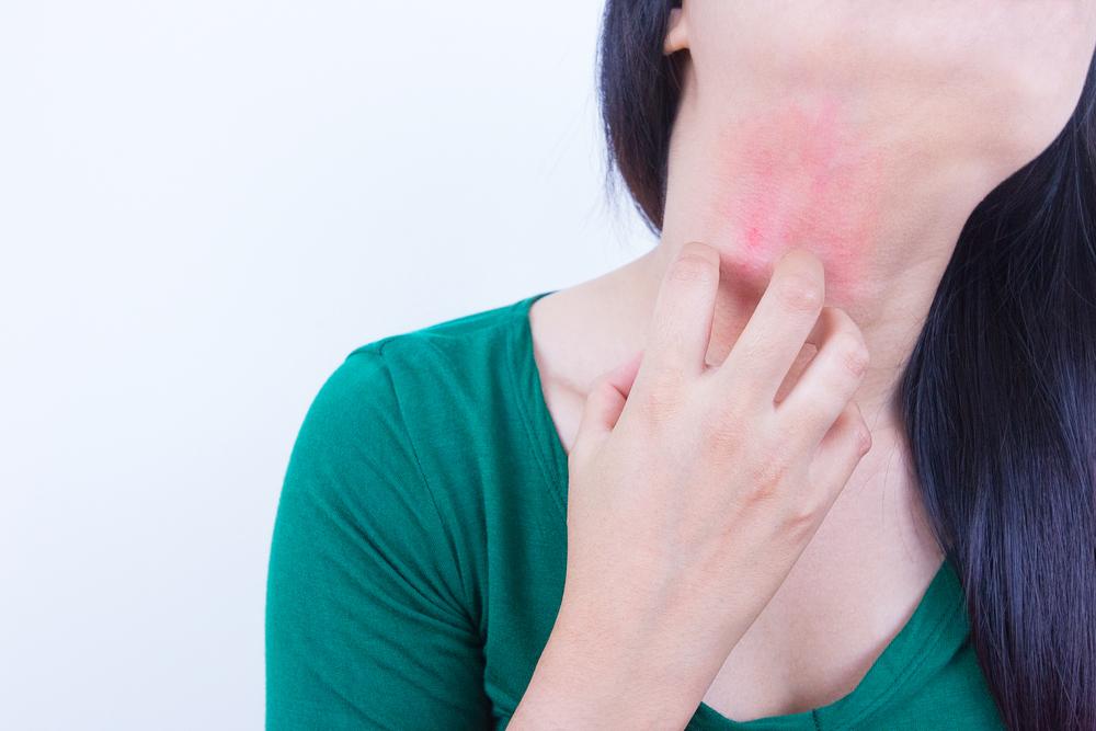 Comprehensive Strategies for Managing Chronic Urticaria