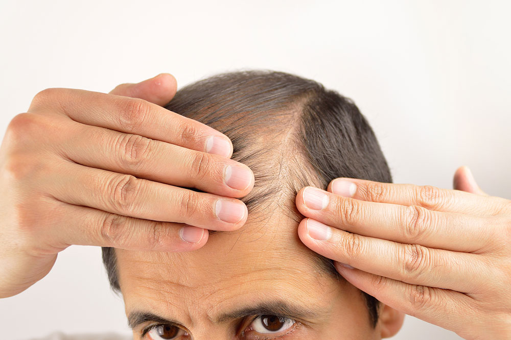Understanding Hair Loss: Symptoms and Causes
