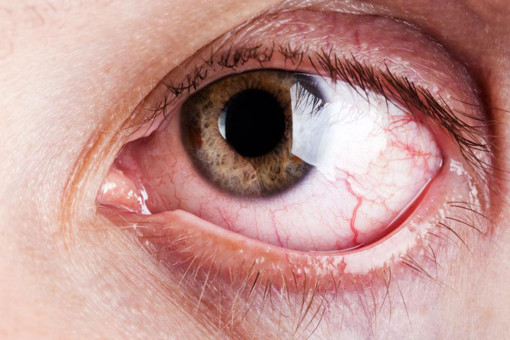 Recognizing the Symptoms of Dry Eye Syndrome