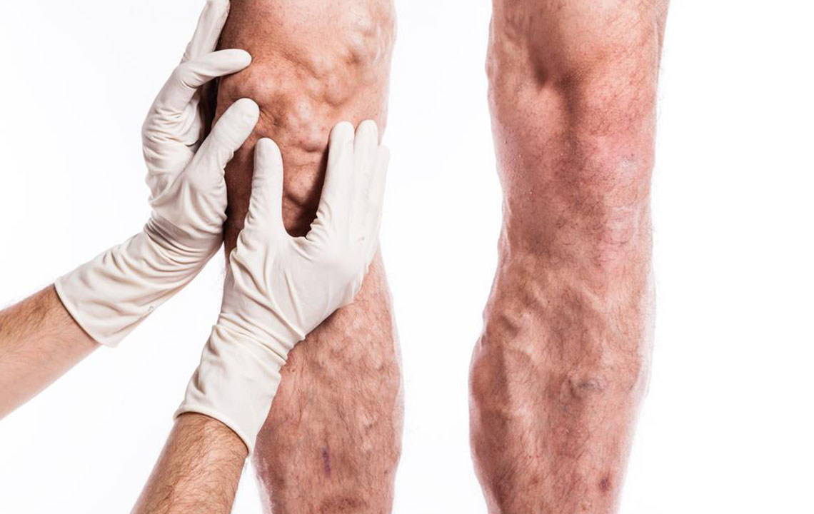 Essential Facts About Deep Vein Thrombosis and How to Protect Yourself