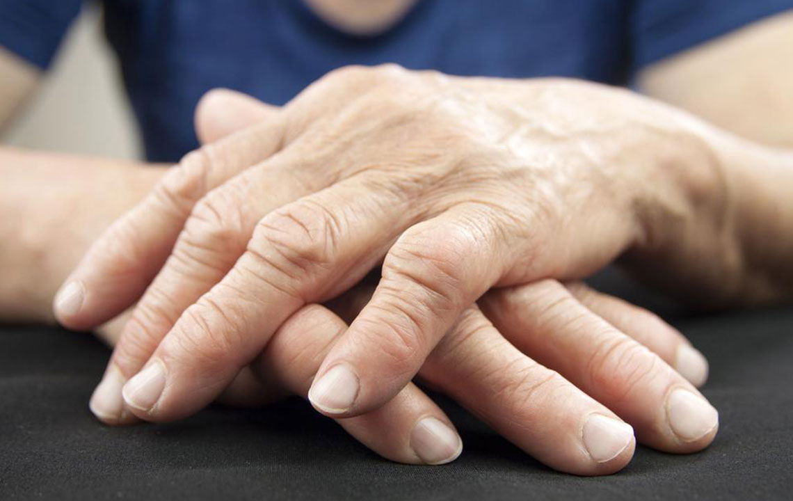 Effective Strategies for Managing Psoriatic Arthritis Symptoms