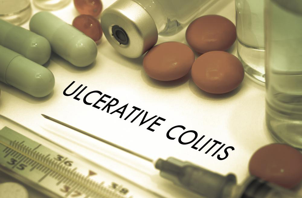 Comprehensive Guide to Managing Ulcerative Colitis