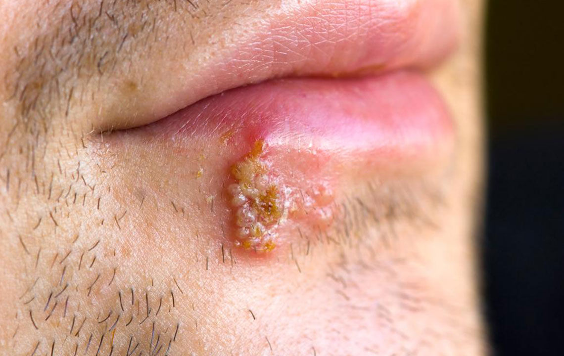 Effective Home Remedies for Speedy Cold Sore Healing