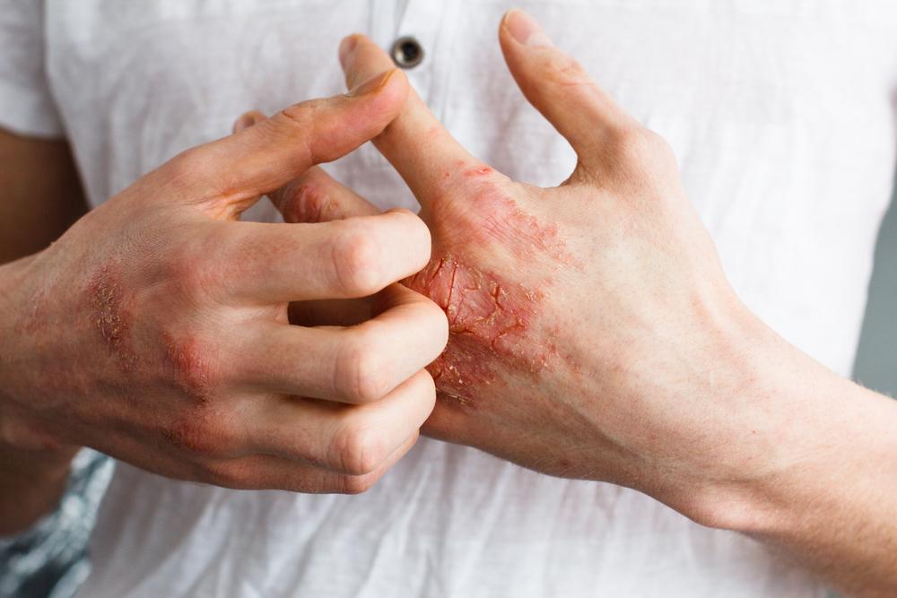 Effective Strategies for Managing Eczema
