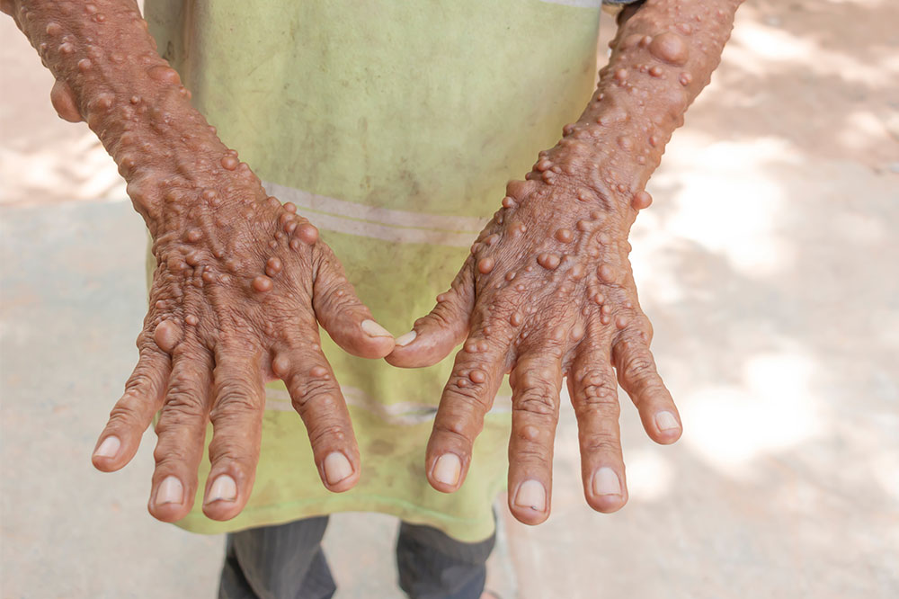 Understanding the Three Variants of Neurofibromatosis