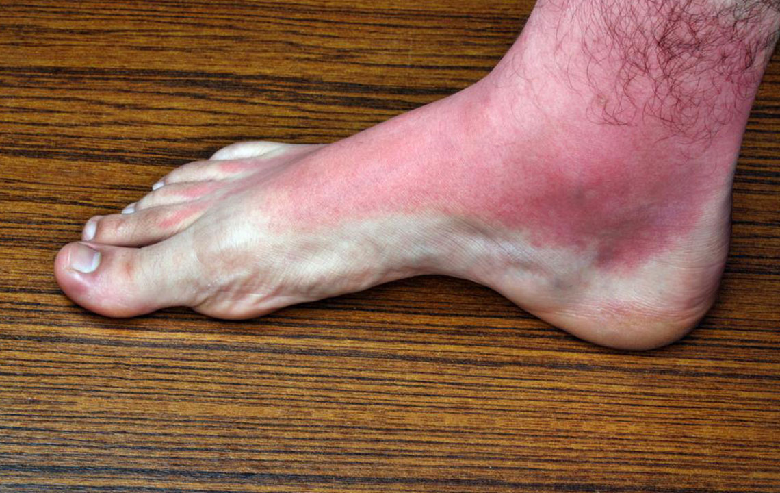 Effective Strategies for Managing and Preventing Heat Rashes