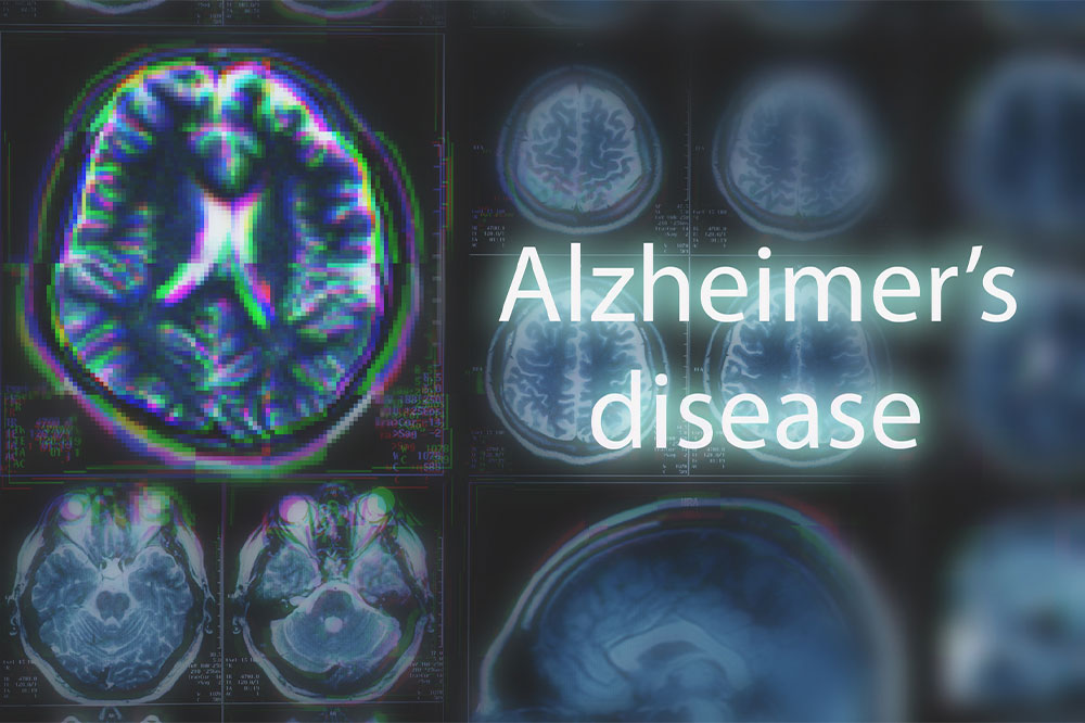 Recognizing the First Indications of Alzheimer’s Disease