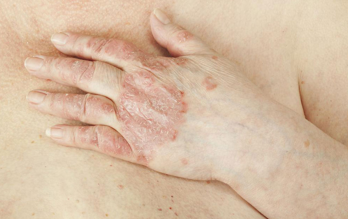 Managing Psoriatic Arthritis: Effective Treatment Strategies