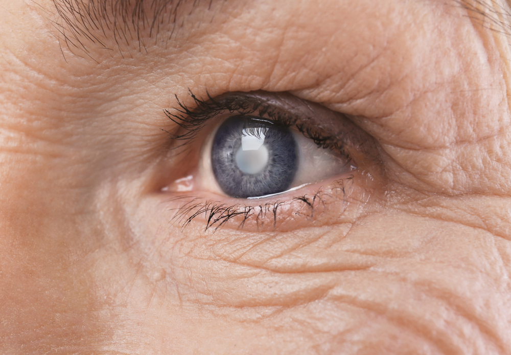 Comprehensive Guide to Cataract: Causes, Symptoms, and Treatment Options
