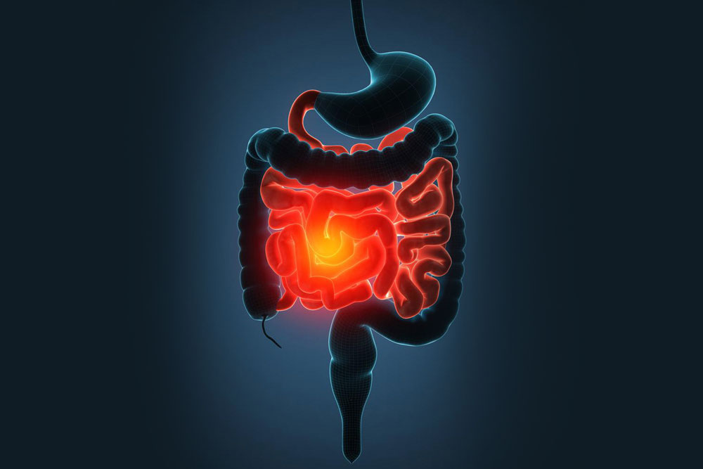 Comprehensive Dietary Strategies for Managing Ulcerative Colitis Effectively