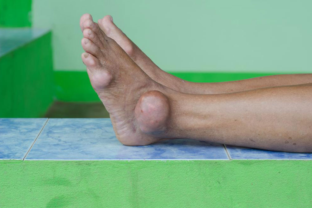 Managing Gout Flare-Ups: Effective Treatment Strategies