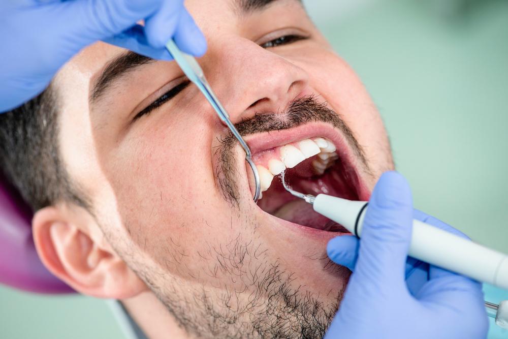 Comprehensive Guide to Effectively Remove Dental Plaque and Tartar for Better Oral Health