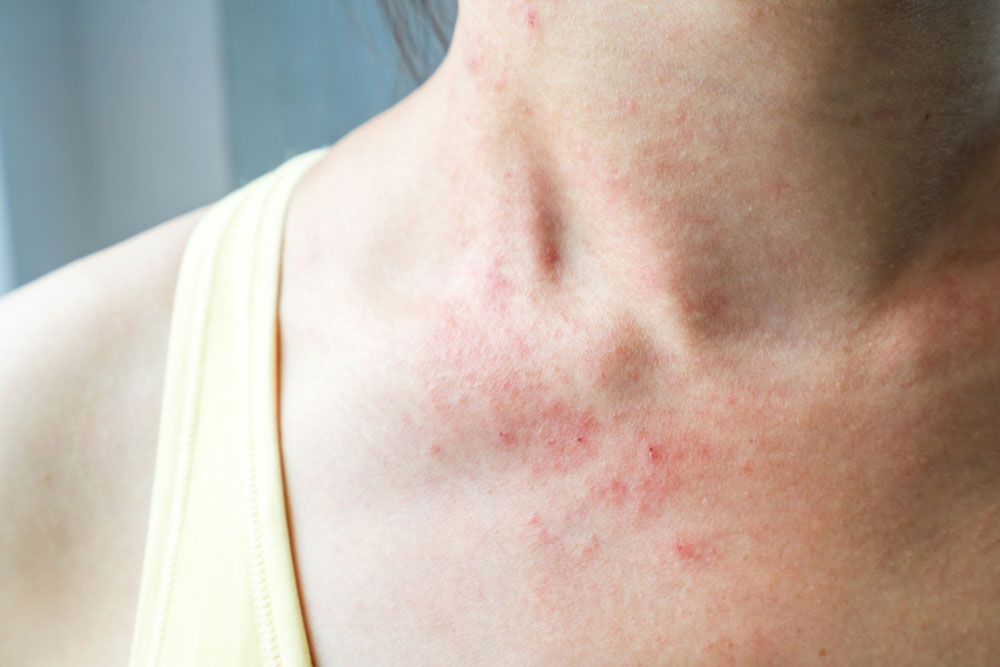 Understanding Mycosis Fungoides: Beyond Skin Rash Indicators