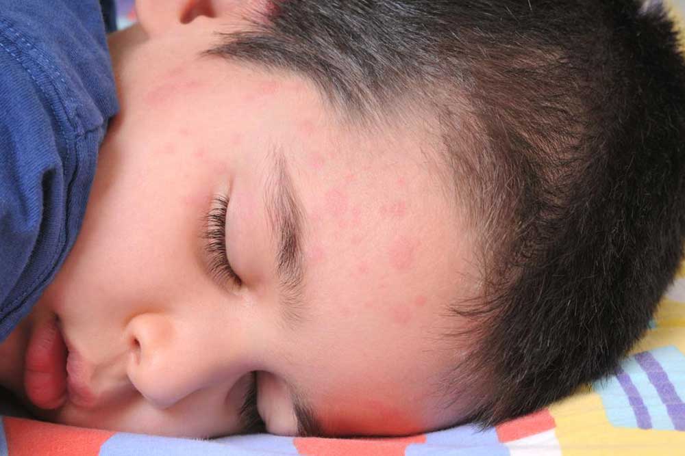 Common Types of Skin Rashes and Their Symptoms