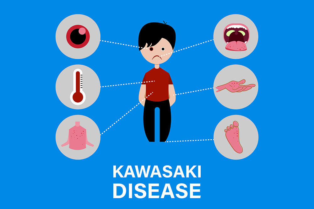 Understanding Kawasaki Disease: Causes and Key Symptoms