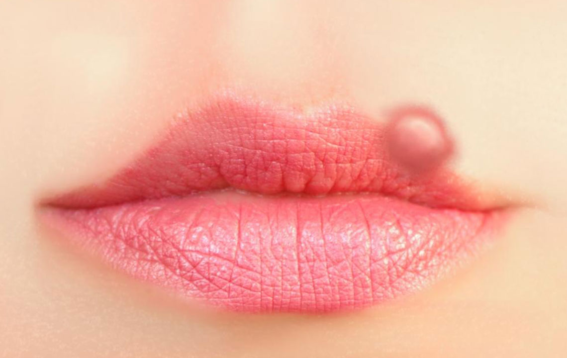 Effective Strategies for Rapid Cold Sore Relief
