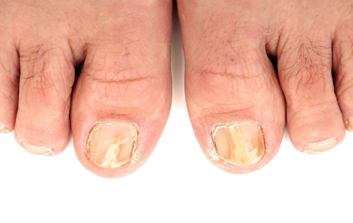 Effective Strategies for Healing Toenail Fungus Naturally and Medically