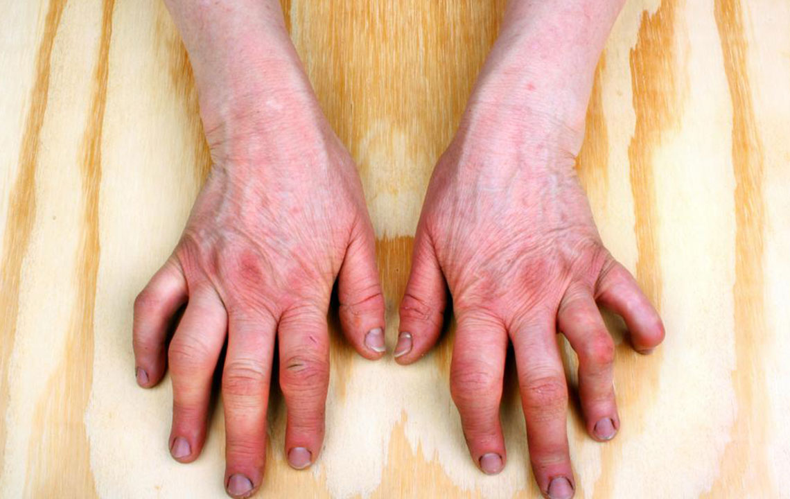 Understanding Rheumatoid Arthritis: Causes, Symptoms, and Care
