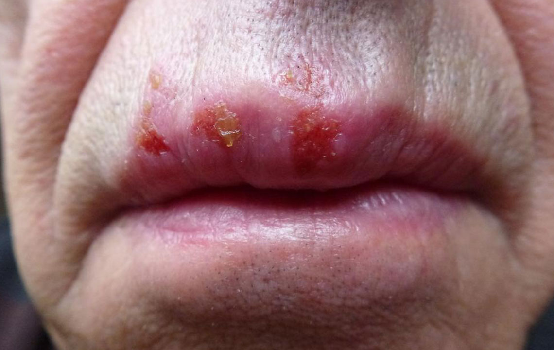 Common Misconceptions About Herpes Debunked