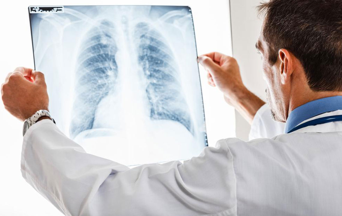 Comprehensive Guide to Pulmonary Embolism: Causes, Symptoms, and Treatment
