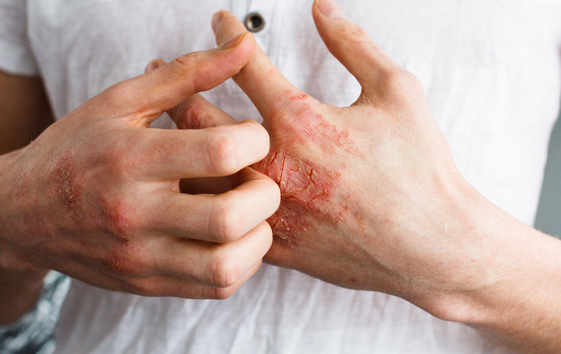 Diet Tips: Foods to Support and Avoid for Eczema Management