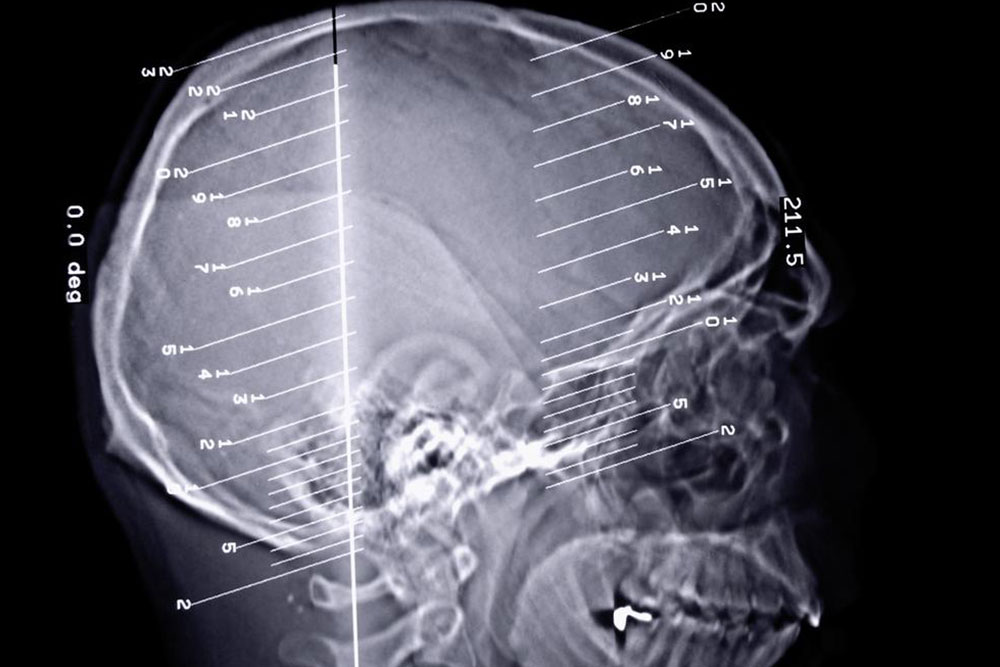 Understanding Epilepsy: Risks and Impact on Daily Life