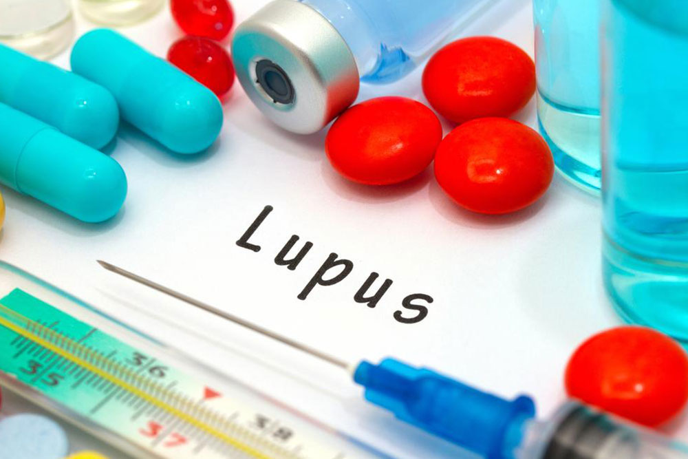 Effective Strategies for Managing Lupus